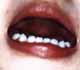 HerpeticAngina1.JPG (4603 bytes)