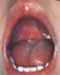 HerpeticAngina3s.JPG (4115 bytes)